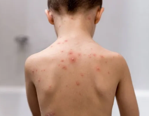 Casos de varicela aumentam no início da primavera na Bahia