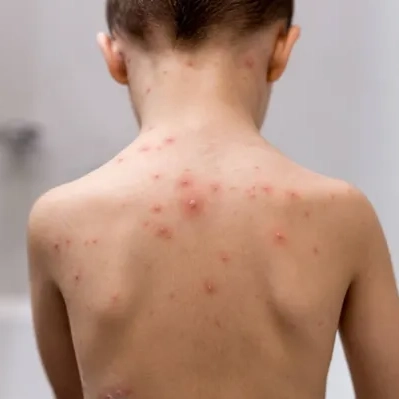 Casos de varicela aumentam no início da primavera na Bahia