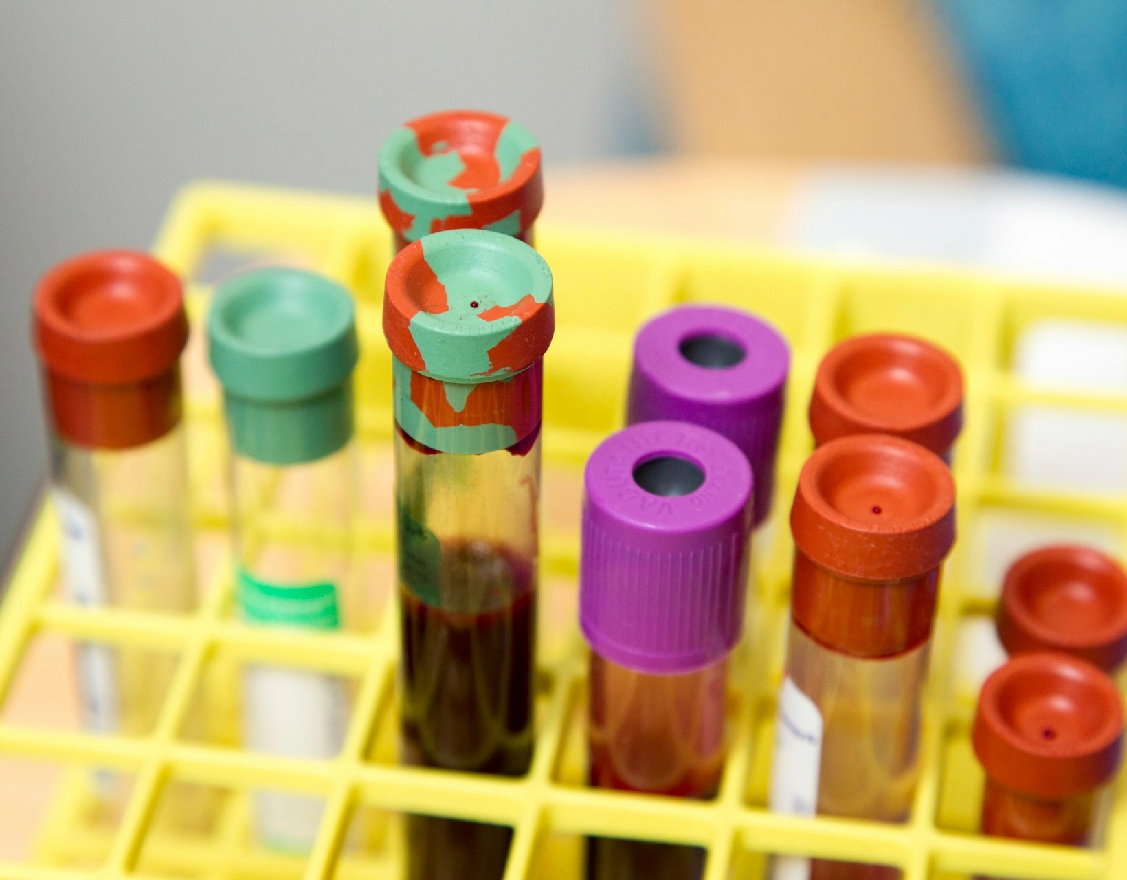 EUA aprovam primeiro exame de sangue que pode diagnosticar Alzheimer
