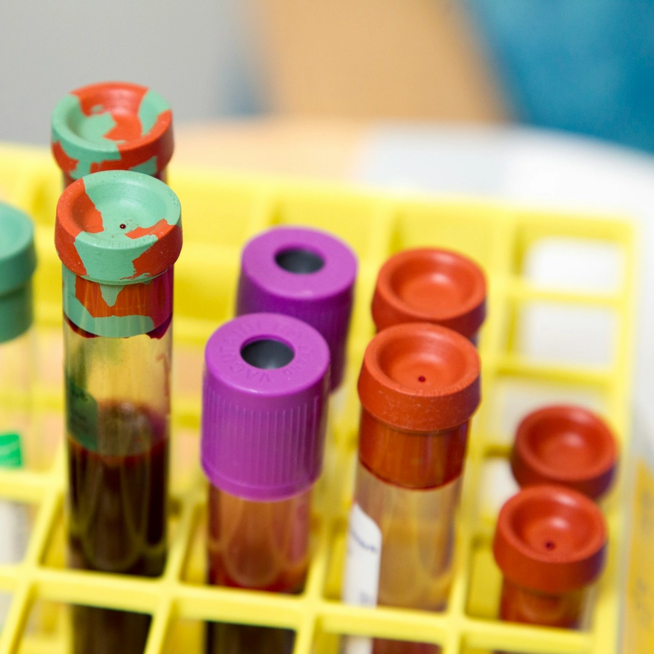 EUA aprovam primeiro exame de sangue que pode diagnosticar Alzheimer