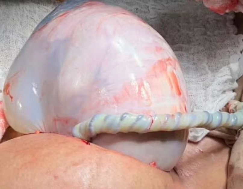 Nascimento raro de gêmeos em Irecê: uma bebê nasce envolta pela bolsa amniótica
