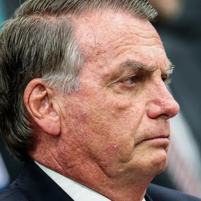 Defesa pede ao STF autorização para cirurgia de Bolsonaro