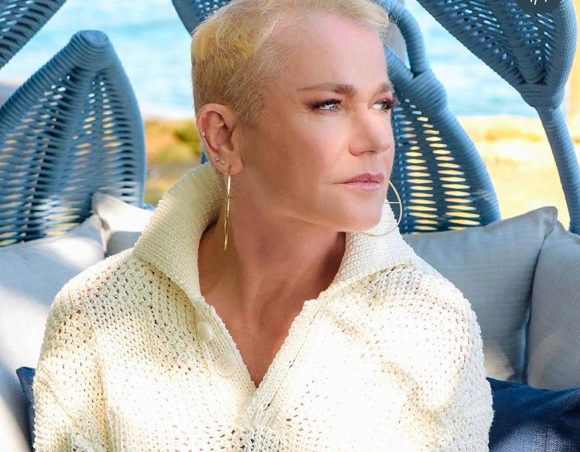 Xuxa realiza implante capilar e fala sobre queda de cabelo